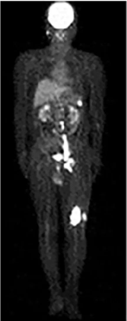 Fig. 6. PET CT demonstrates increased uptake in the left  distal femur and lymph nodes of left inguinal, femoral, iliac,  and paraaortic areas.