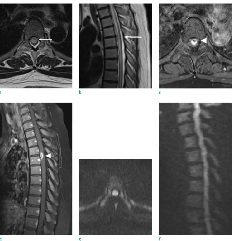 Fig. 1.  Magnetic resonance imaging of the thoracic spine of a 43-year-old woman who experienced sudden weakness of  the left lower leg while climbing stairs