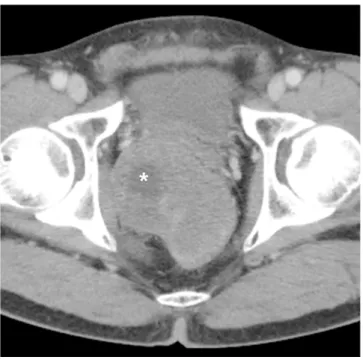 Table 1. Imaging Features of Benign and Malignant Perirectal Cystic Lesions
