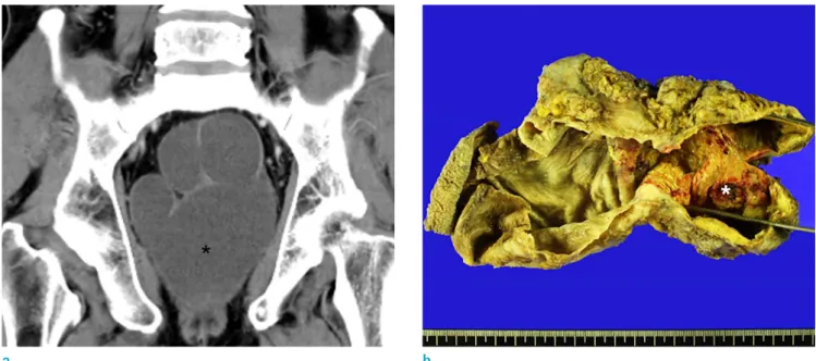 Fig. 1.  Tailgut cyst in an age 59 male. (a) Contrast-enhanced coronal CT scan shows a multilocular cystic lesion (*) without  solid component in the perirectal region