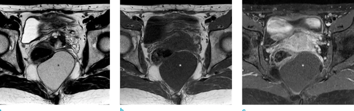 Fig. 6. A dermoid cyst in an age 48 female. (a, b) Sagittal and axial T2- and T1-weighted MR image show a thin-walled  lobulated cystic mass (*) without internal solid portion