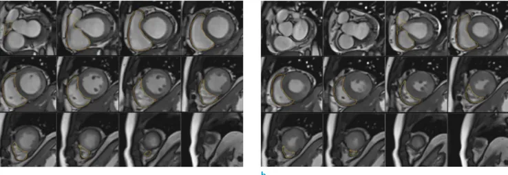 Fig. 3. RV quantitative assessment with short axis cine. For RV quantitative assessment, a stack of short axis slices  containing the entire RV is required and an endocardial contour should be drawn in both the diastole (a) and systole (b)  phases