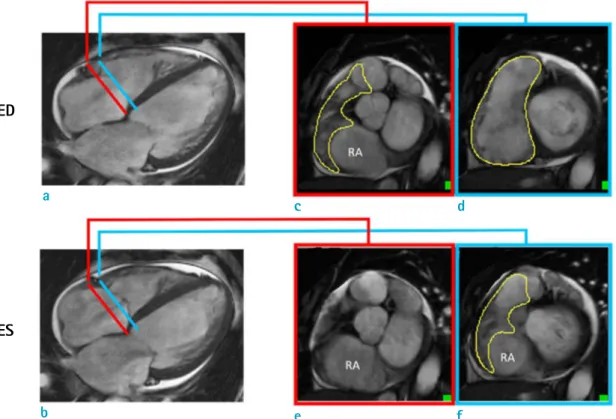 Fig. 5. Pitfall of RV short-axis evaluation: use different planes together. Short-axis evaluation of RV requires extra care  in basal slice contouring, and it is helpful to use different planes together