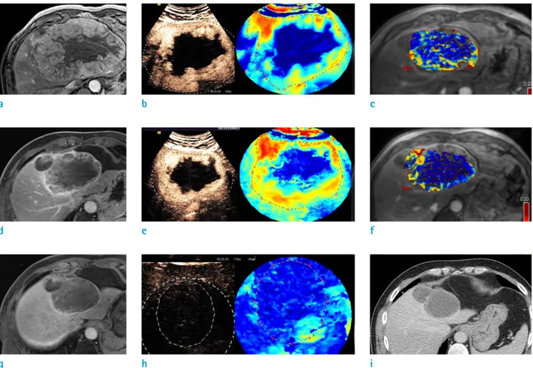 Fig. 3.  A 48-year-old male with locally advanced HCC. Huge hypervascular HCC with central necrosis was noted mainly in  the left hepatic lobe in pretreatment (a-c), immediate (d-f) and 3 months after the end of CCRTx (g, h)