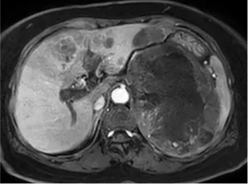 Fig. 1.  (e-g) Dynamic enhanced T1 fat suppressed images  showing arterial nodular enhancement and delayed  enhancement of peripheral part