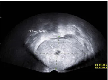 Fig. 2. Axial contrast-enhanced computed tomography scan  revealed a 9.3 × 7.0 cm-sized predominantly solid mass in  the rectouterine pouch with heterogeneous enhancement