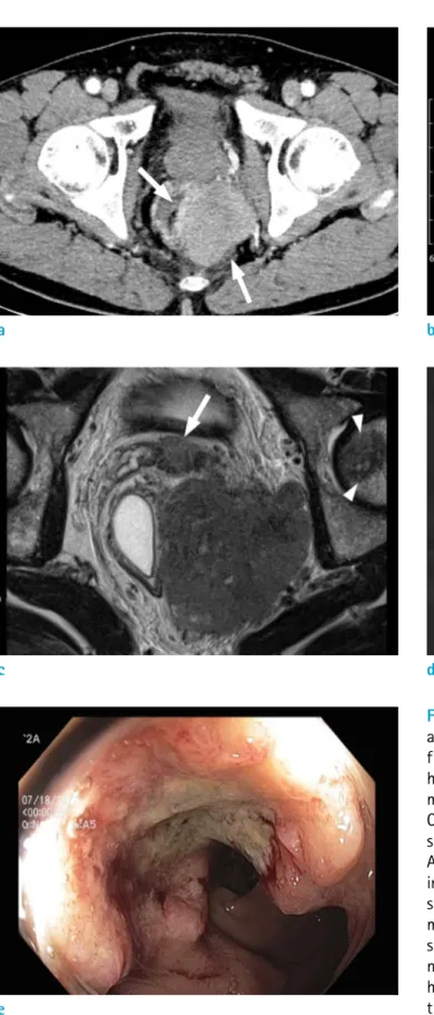 Fig. 1. An age 62 male with collision tumor of rectal  adenocarcinoma and DLBCL. (a) Axial CT image obtained  from portal venous phase shows a lobulated, relatively  homogeneous enhancing mass (arrows) in the left  mesorectum