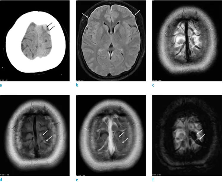 Fig. 1. An age 26 female with a headache. (a) The non-contrast CT scan shows a hyperdense cortical vein at the left  cerebral vertex (arrows)