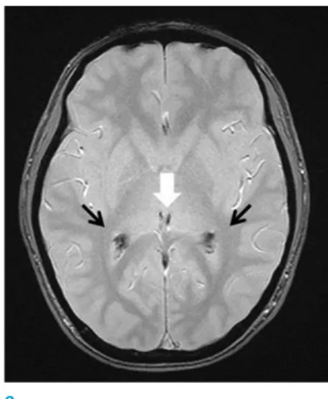 Fig. 1.  MR images of choroid  plexus hemosiderosis in a  15-year-old male with acute lymphoblastic  leukemia in whom repeated blood  transfusions led to iron overload
