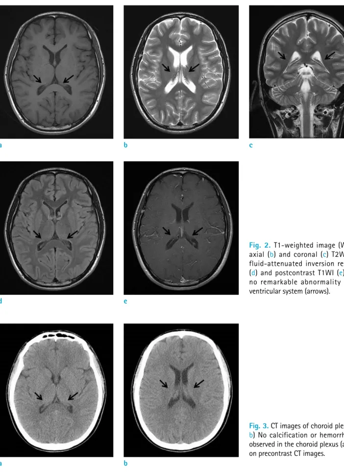 Fig. 2. T1-weighted image (WI) (a),  axial (b) and coronal (c) T2WI, and  fluid-attenuated inversion recovery  (d) and postcontrast T1WI (e) show  no remarkable abnormality in the  ventricular system (arrows)