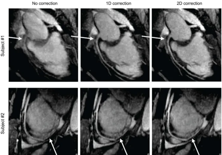 Figure 4a depicts estimated respiratory motions using  the proposed 2D navigator (solid blue) and 1D diaphragm 