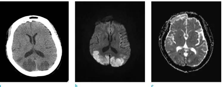 Fig. 1. (a) Low densities in both parietal and occipital lobes on a CT. (b, c) Diffusion restriction of both parietal, occipital,  and posterior temporal lobes, mainly cortex and subcortical white matter