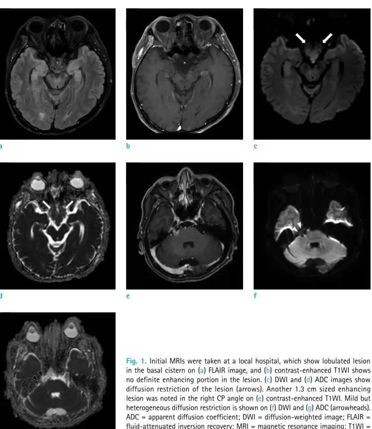 Fig. 1.  Initial MRIs were taken at a local hospital, which show lobulated lesion  in the basal cistern on (a) FLAIR image, and (b) contrast-enhanced T1WI shows  no definite enhancing portion in the lesion