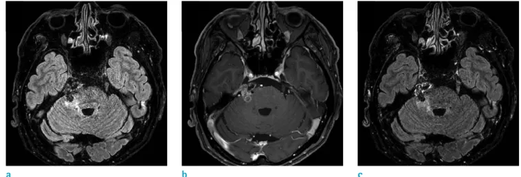 Fig. 3.  Second MRIs were taken 5 months after the initial MRIs. The high signal intensity lesion on (a) FLAIR image is more  prominent since the previous examination, and the enhancing lesion on (b) T1WI has increased in size as well, with minimal  enhanc