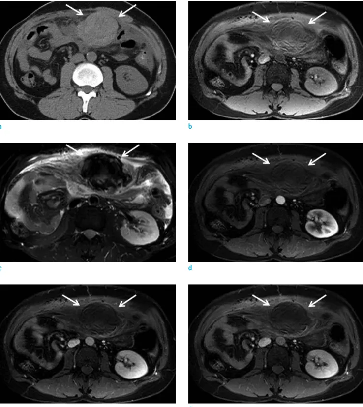 Fig. 1. A 40-year-old man with spontaneous rupture of intraperitoneal metastatic mass secondary to HCC