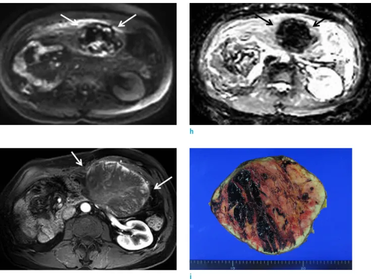 Fig. 1.  On DWI (b = 800 s/mm 2 ) (g) and ADC map (h), the mass (arrows) does not reveal remarkable diffusion restriction