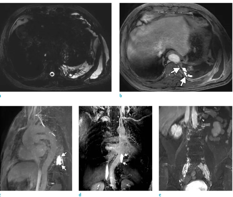 Fig. 2. MR lymphangiography for visualizing the cisterna chyli and leakage site. (a) A T2W image showing postoperative  multiloculated fluid collection in the left pleural space and chest wall