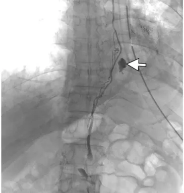 Fig. 3. Conventional lymphangiography with thoracic  duct embolization. (a) The cisterna chyli (arrowhead) was  selected using a 2.0 Fr Progreat catheter, and Lipiodol  uptake was visualized along the thoracic duct course