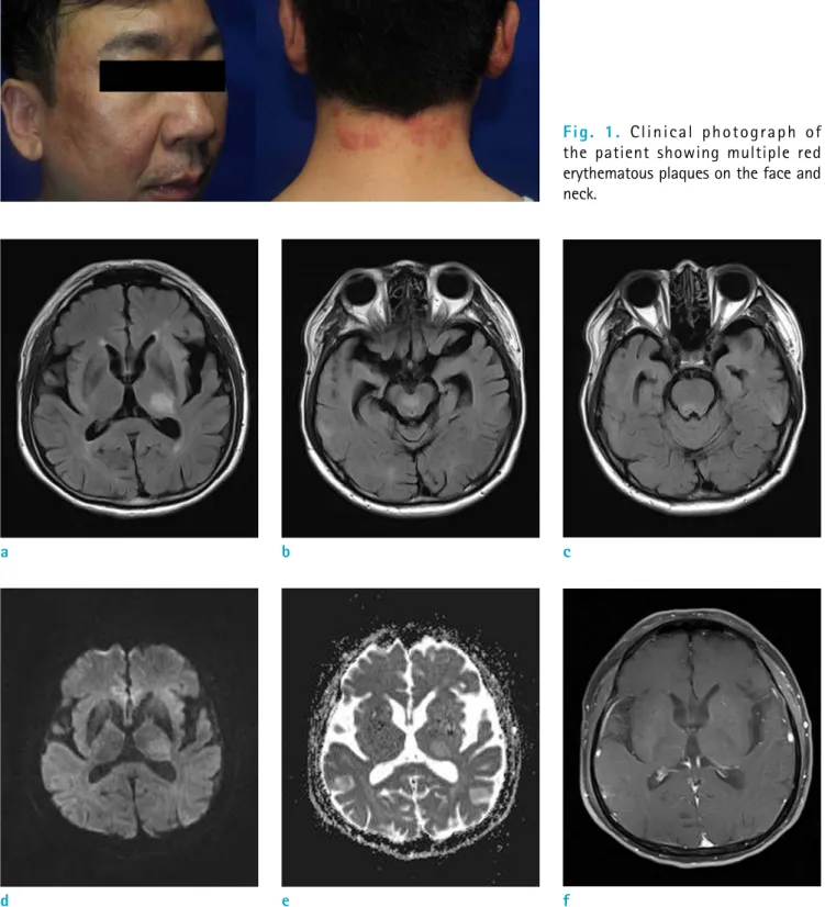Fig. 2.  Axial FLAIR MR images (a-c) revealed multiple hyperintense lesions in the left frontal lobe, left temporal lobe, left  thalamus, pons and midbrain that showed no definite diffusion restriction on DWI (d, e) and no enhancement on  contrast-enhanced