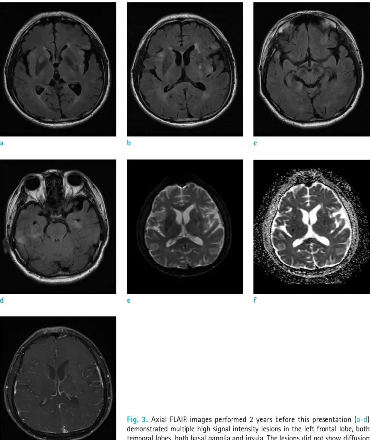 Fig. 3. Axial FLAIR images performed 2 years before this presentation (a-d)  demonstrated multiple high signal intensity lesions in the left frontal lobe, both  temporal lobes, both basal ganglia and insula