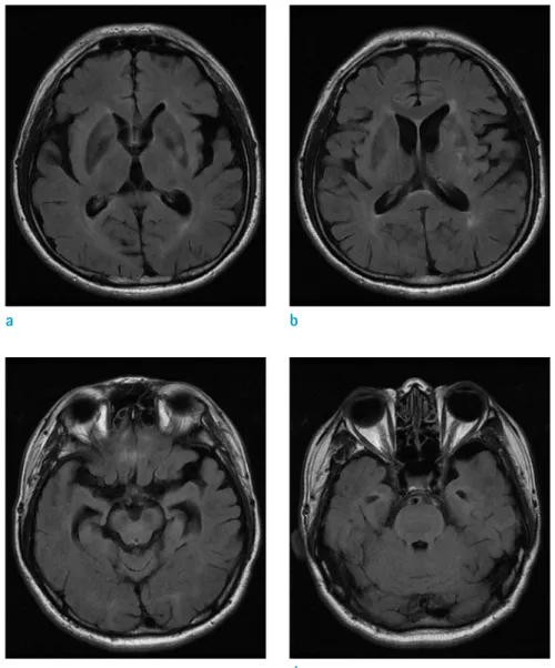 Fig. 4. Follow up FLAIR images taken  after steroid therapy (a-d) showing the  extent of multiple hyperintense lesions  that diminished in the whole brain
