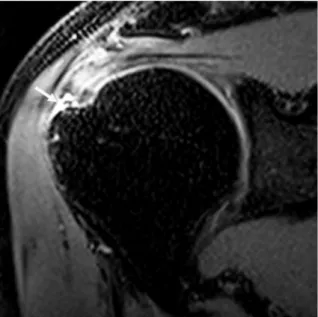 Fig. 3. Non-arthrographic MR images show arthroscopically-proven partial-thickness bursal-sided tear of SST-IST and  intact SCT in a 55-year-old man