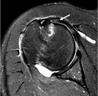 Fig. 4. Non-arthrographic MR images show arthroscopically-proven grade 2 partial-thickness articular-sided tear of the  SCT in a 56-year-old woman