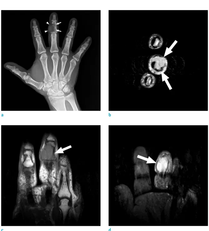 Fig. 1. A 71-year-old-man with DLBCL involving 3rd finger. (a) Plain radiograph shows osteolytic bony mass (arrows) with  soft-tissue component (arrowheads) involving right third middle phalanx