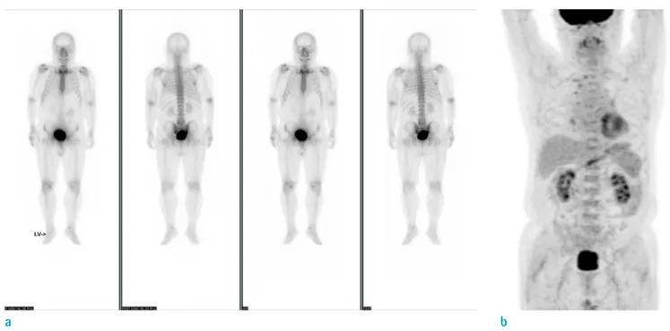 Fig. 3. Systemic evaluation of other organ involvement. (a) Bone scan reveals no evidence of other bone involvement