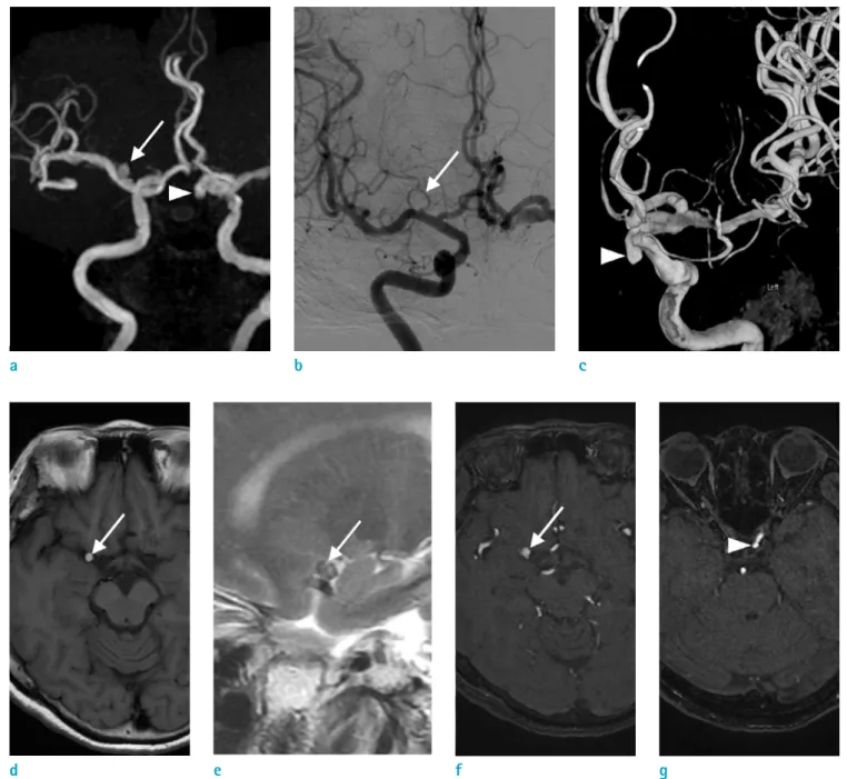 Fig. 1.  66-year-old woman with a diagnostic pitfall on TOF MR angiography.  TOF MRA (a) shows two intracranial  aneurysms; one is located at the M1 segment of right middle cerebral artery (MCA; arrow) and the clinoid segment of left  internal carotid arte