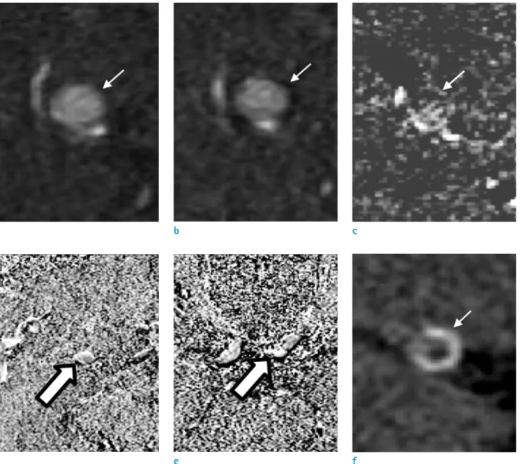 Fig. 3. Phase shift TOF MRA (a: in-phase, b: out-of-phase) did not showed chemical artifact around small hyperintense  lesion (arrows) in the right middle cerebral artery