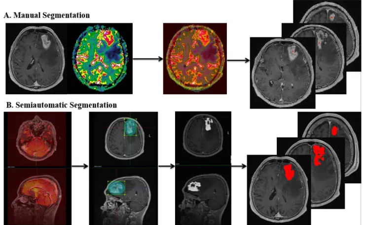 Fig. 2. Flowchart summarizing the manual and semiautomatic segmentation method. (a) Contrast enhanced T1 weighted  images and nCBV maps were co-registered in a patient with glioblastoma