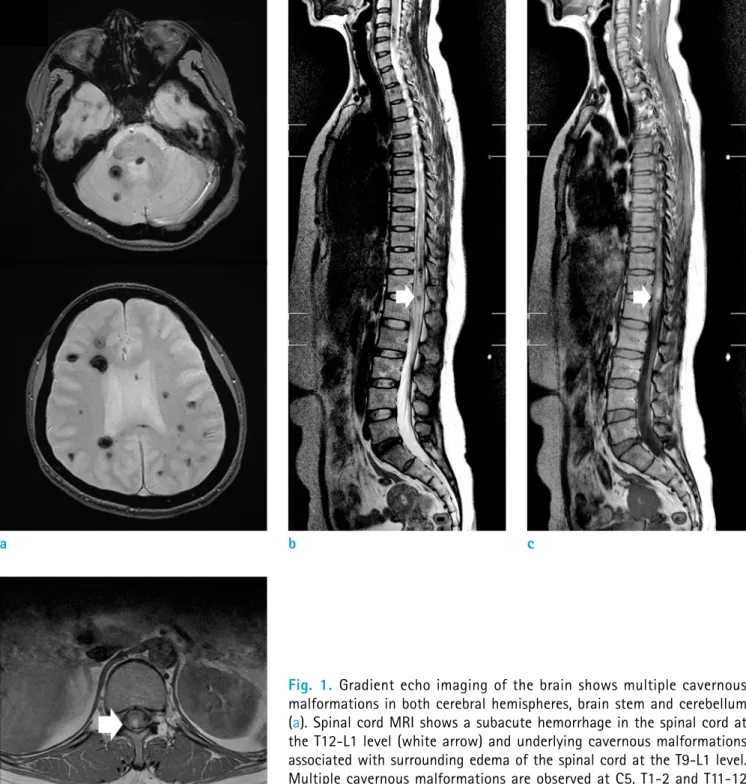 Fig. 1.  Gradient echo imaging of the brain shows multiple cavernous  malformations in both cerebral hemispheres, brain stem and cerebellum  (a)