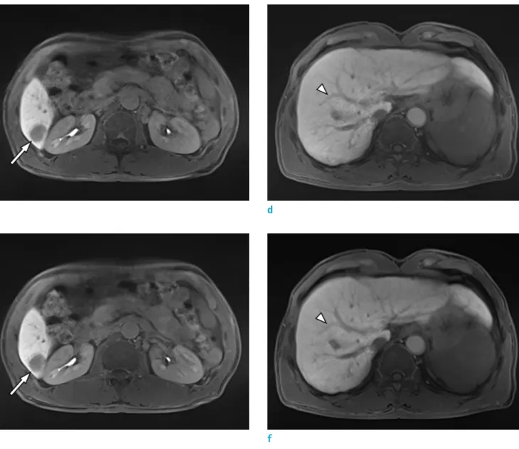 Fig. 1. Axial free-breathing 3D radial GRE with GA (c, d) and 3D radial GRE with ILAB (e, f) show blurred resolution of the  tumor (arrows) and margin of the intrahepatic vessel (arrowheads)