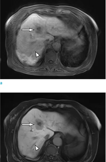 Fig. 2.  MR images in a 75-year-old woman with  intrahepatic, mass-forming cholangiocarcinoma