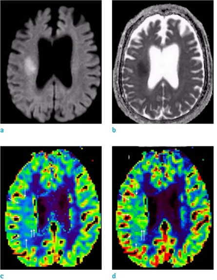 Fig. 1.  Diffusion-weighted imaging (DWI)  (a) and apparent diffusion coefficient map  (b) revealed diffusion restriction along the  right corona radiata of the corticospinal tract