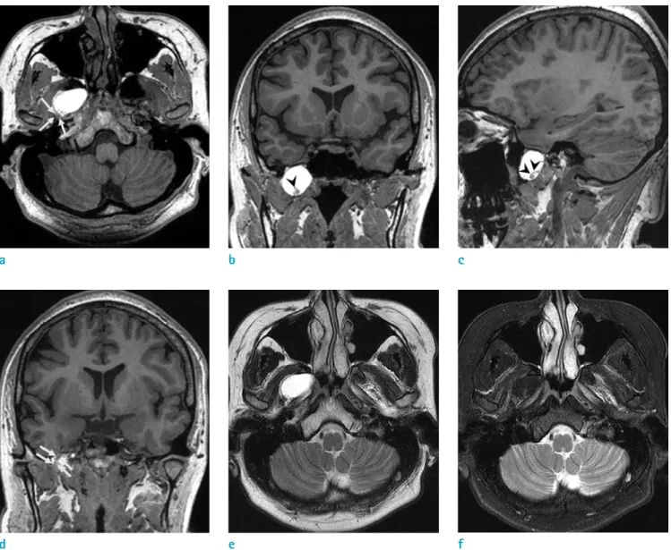 Fig. 1.  A 24-year-old woman presented with a complaint of recurrent seizures over the past 10 years