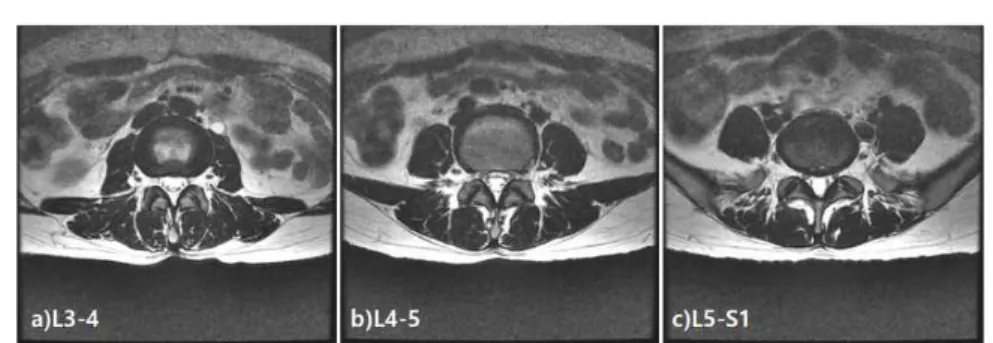 Fig. 2. L-spine MRI axial T2-weighted image (2019-05-14). a) L3-4, b) L4-5, c) L5-S1 level 5) 계통문진 (1) 맥 : 沈細滑 (2) 설 : 舌淡紅 (3) 음 식 : 식욕 양호, 소화 양호 (4) 대 변 : 양호 (5) 소 변 : 양호 (6) 수 면 : 양호 11