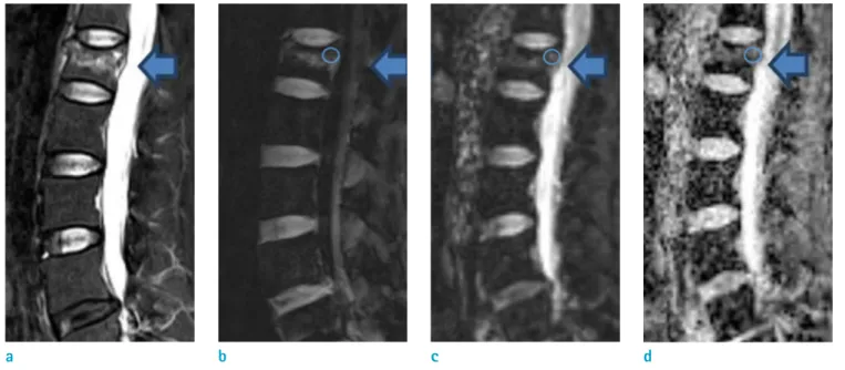 Fig. 1.  Benign osteoporotic vertebral fracture in a 57-year-old female who presented with low back pain