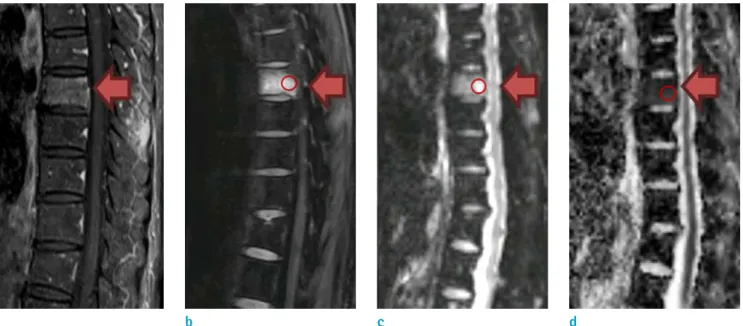 Fig. 2. Neoplastic vertebral fracture of a 60-year-old female with breast cancer who presented with back pain