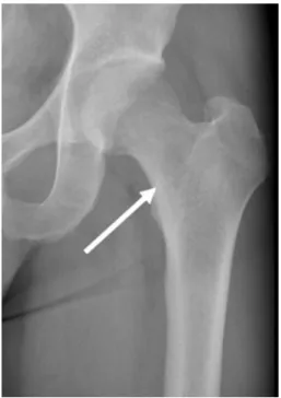 Fig. 2.  Computed tomography (CT)  scan of left femur. (a) The coronal  image displays an intramedullary  mass in the intertrochanteric  region of the left femur (white  arrow)