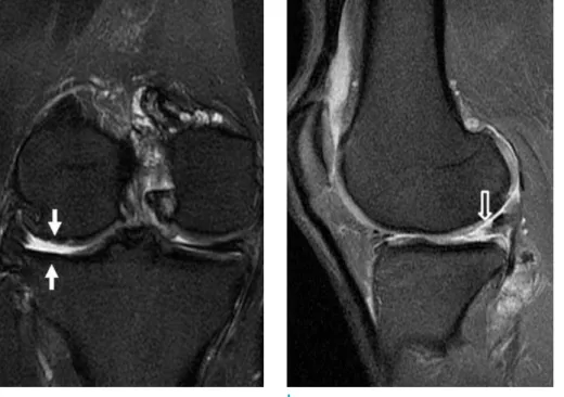 Fig. 1.  Right knee MRI of a  44-year-old male presenting with  knee pain previously treated at  an outside hospital
