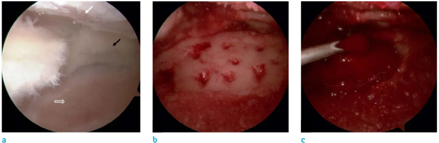 Fig. 2. Arthroscopic finding during the bone marrow aspirates concentrate (BMAC) transplantation