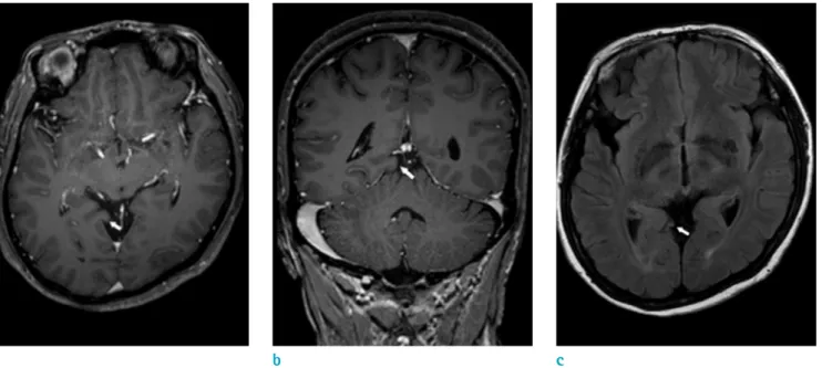 Fig. 1. Magnetic resonance images from a 57-year-old woman with idiopathic lingual gyrus herniation