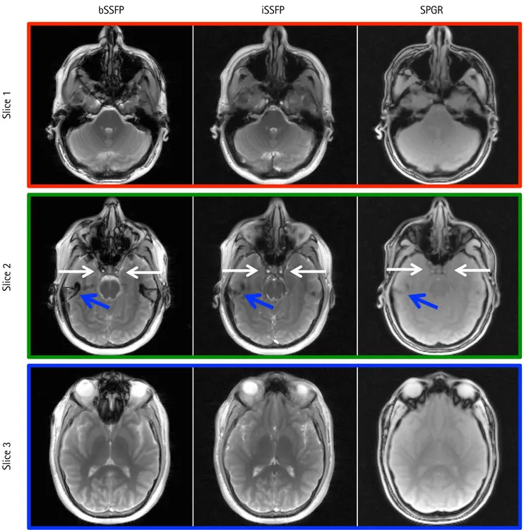 Figure 2 provides the brain scans from bSSFP, iSSFP, and 