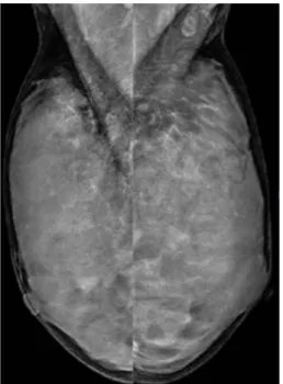 Fig. 1. (a) Mammogram mediolateral oblique (MLO) view reveals extremely  dense breasts that make it difficult to evaluate the mass lesion