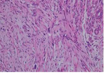 Fig. 3. On pathology examination, (a) low-power field (× 40) and (b) high-power field (× 200) images of the tumor reveal  biphasic proliferation and a multinodular growth pattern and was composed of spindle cells without significant atypia, cuff  formation