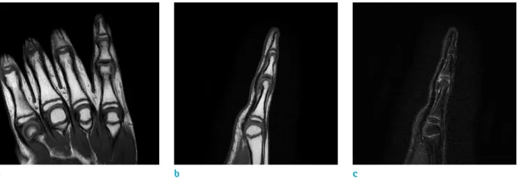 Fig. 1. Simple radiograph of right fifth finger shows no  fracture line or other abnormal bone lesion.
