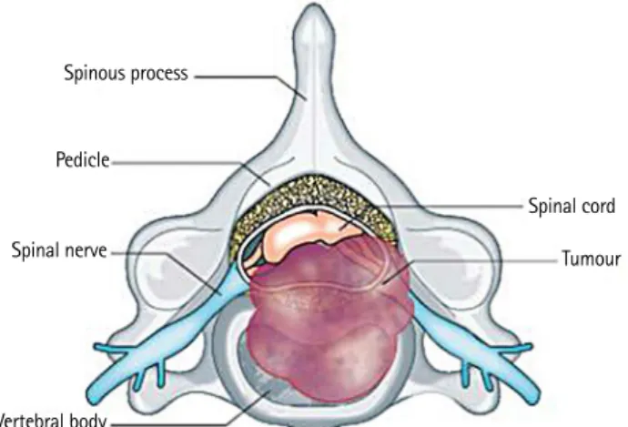 Fig. 2.  Schematic diagram of the surgical classification of spinal tumors, from Choi et al