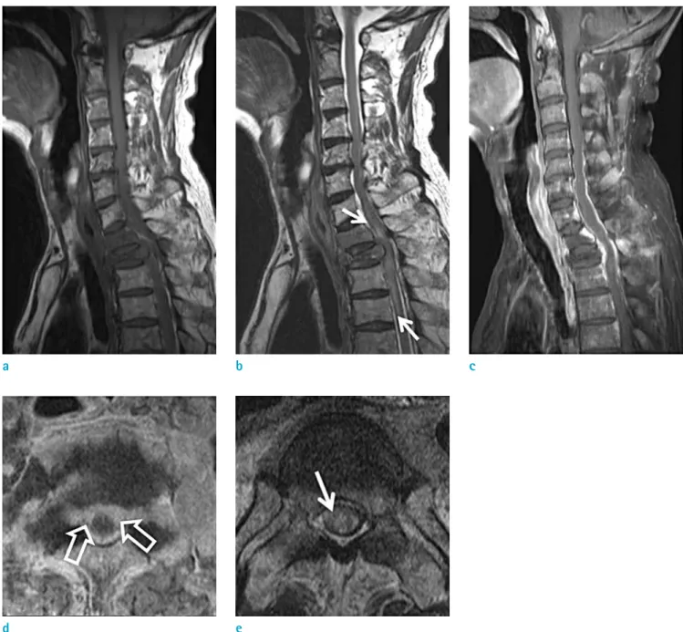 Fig. 6.  Neural compression: 59-year-old man with esophageal cancer visited for weakness of both lower extremities